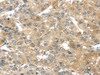 Immunohistochemistry of paraffin-embedded Human liver cancer tissue using TMPRSS4 Polyclonal Antibody at dilution 1:50