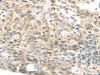 Immunohistochemistry of paraffin-embedded Human esophagus cancer tissue using TMPRSS4 Polyclonal Antibody at dilution 1:50