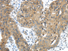 Immunohistochemistry of paraffin-embedded Human breast cancer tissue using TMPRSS11E Polyclonal Antibody at dilution 1:45
