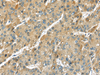 Immunohistochemistry of paraffin-embedded Human liver cancer using TMPRSS11D Polyclonal Antibody at dilution of  1/35