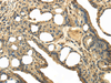 Immunohistochemistry of paraffin-embedded Human thyroid cancer tissue using TRPC4AP Polyclonal Antibody at dilution 1:40