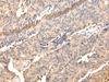 Immunohistochemistry of paraffin-embedded Human prostate cancer using SDCBP Polyclonal Antibody at dilution of  1/40