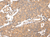 Immunohistochemistry of paraffin-embedded Human prostate cancer using ALDH3A2 Polyclonal Antibody at dilution of  1/20