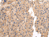 Immunohistochemistry of paraffin-embedded Human liver cancer using VAMP5 Polyclonal Antibody at dilution of  1/25