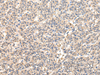 Immunohistochemistry of paraffin-embedded Human liver cancer tissue using VPS45 Polyclonal Antibody at dilution 1:50