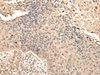 Immunohistochemistry of paraffin-embedded Human esophagus cancer tissue using VPS35 Polyclonal Antibody at dilution 1:45