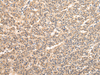 Immunohistochemistry of paraffin-embedded Human liver cancer tissue using VPS33B Polyclonal Antibody at dilution 1:40