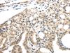 Immunohistochemistry of paraffin-embedded Human thyroid cancer tissue using INHBB Polyclonal Antibody at dilution 1:45