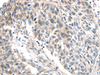 Immunohistochemistry of paraffin-embedded Human lung cancer using IQGAP2 Polyclonal Antibody at dilution of  1/40