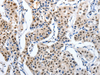 Immunohistochemistry of paraffin-embedded Human lung cancer tissue using MAGEA6 Polyclonal Antibody at dilution 1:120
