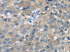 Immunohistochemistry of paraffin-embedded Human breast cancer using PBOV1 Polyclonal Antibody at dilution of  1/20