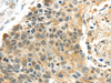 Immunohistochemistry of paraffin-embedded Human esophagus cancer using PROX1 Polyclonal Antibody at dilution of  1/40