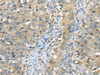 Immunohistochemistry of paraffin-embedded Human breast cancer using ISM2 Polyclonal Antibody at dilution of  1/45