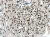 Immunohistochemistry of paraffin-embedded Human breast cancer using TRIM24 Polyclonal Antibody at dilution of  1/40