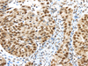 Immunohistochemistry of paraffin-embedded Human breast cancer tissue using TRIM33 Polyclonal Antibody at dilution 1:40