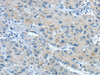 Immunohistochemistry of paraffin-embedded Human liver cancer using TNIP1 Polyclonal Antibody at dilution of  1/35