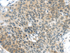 Immunohistochemistry of paraffin-embedded Human esophagus cancer tissue using TSPY1 Polyclonal Antibody at dilution 1:40