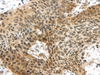 Immunohistochemistry of paraffin-embedded Human esophagus cancer tissue using TTBK2 Polyclonal Antibody at dilution 1:45