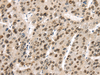 Immunohistochemistry of paraffin-embedded Human liver cancer using TUSC5 Polyclonal Antibody at dilution of  1/40