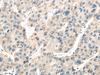 Immunohistochemistry of paraffin-embedded Human liver cancer tissue using TXNIP Polyclonal Antibody at dilution 1:50