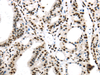 Immunohistochemistry of paraffin-embedded Human thyroid cancer using DDX39B Polyclonal Antibody at dilution of  1/40