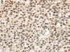 Immunohistochemistry of paraffin-embedded Human breast cancer using UBA1 Polyclonal Antibody at dilution of  1/40