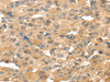 Immunohistochemistry of paraffin-embedded Human liver cancer tissue using UCP1 Polyclonal Antibody at dilution 1:40
