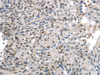 Immunohistochemistry of paraffin-embedded Human breast cancer tissue using KDM5C Polyclonal Antibody at dilution 1:45