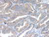 Immunohistochemistry of paraffin-embedded Human esophagus cancer using RAB2A Polyclonal Antibody at dilution of  1/40