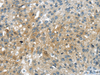 Immunohistochemistry of paraffin-embedded Human breast cancer using UPP2 Polyclonal Antibody at dilution of  1/35