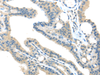 Immunohistochemistry of paraffin-embedded Human thyroid cancer tissue using VPS36 Polyclonal Antibody at dilution 1:40