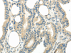 Immunohistochemistry of paraffin-embedded Human thyroid cancer tissue using WNT6 Polyclonal Antibody at dilution 1:35