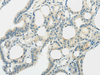Immunohistochemistry of paraffin-embedded Human thyroid cancer using SLC7A11 Polyclonal Antibody at dilution of  1/35