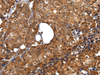 Immunohistochemistry of paraffin-embedded Human breast cancer tissue using ZBTB2 Polyclonal Antibody at dilution 1:40