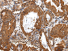 Immunohistochemistry of paraffin-embedded Human esophagus cancer tissue using ZBTB2 Polyclonal Antibody at dilution 1:40