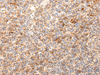 Immunohistochemistry of paraffin-embedded Human liver cancer using ZNF365 Polyclonal Antibody at dilution of  1/20