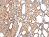 Immunohistochemistry of paraffin-embedded Human thyroid cancer tissue using AQP7 Polyclonal Antibody at dilution 1:40