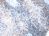 Immunohistochemistry of paraffin-embedded Human esophagus cancer tissue using COLEC12 Polyclonal Antibody at dilution 1:40