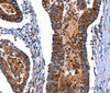 Immunohistochemistry of paraffin-embedded Human colon cancer tissue using ITGA7 Polyclonal Antibody at dilution 1:35