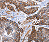 Immunohistochemistry of paraffin-embedded Human esophagus cancer tissue using ITGA7 Polyclonal Antibody at dilution 1:35