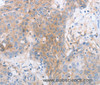 Immunohistochemistry of paraffin-embedded Human esophagus cancer tissue using CD85d Polyclonal Antibody at dilution 1:30