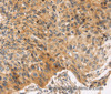 Immunohistochemistry of paraffin-embedded Human esophagus cancer using JNK2 Polyclonal Antibody at dilution of 1:30
