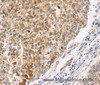 Immunohistochemistry of paraffin-embedded Human lung cancer using JNK2 Polyclonal Antibody at dilution of 1:30