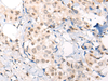 Immunohistochemistry of paraffin-embedded Human breast cancer tissue  using VPS51 Polyclonal Antibody at dilution of 1:65(×200)