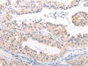 Immunohistochemistry of paraffin-embedded Human liver cancer tissue  using ANAPC15 Polyclonal Antibody at dilution of 1:50(×200)