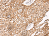 Immunohistochemistry of paraffin-embedded Human lung cancer tissue  using C14orf169 Polyclonal Antibody at dilution of 1:45(×200)