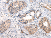 Immunohistochemistry of paraffin-embedded Human cervical cancer tissue  using C16orf45 Polyclonal Antibody at dilution of 1:45(×200)