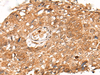Immunohistochemistry of paraffin-embedded Human lung cancer tissue  using KLHL36 Polyclonal Antibody at dilution of 1:55(×200)