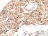 Immunohistochemistry of paraffin-embedded Human esophagus cancer tissue  using KNOP1 Polyclonal Antibody at dilution of 1:85(×200)