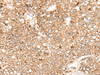 Immunohistochemistry of paraffin-embedded Human liver cancer tissue  using C1S Polyclonal Antibody at dilution of 1:55(×200)